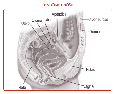 endometriose